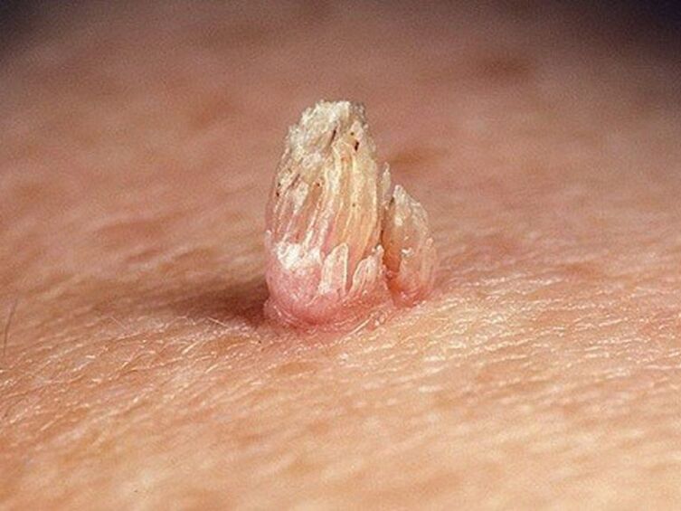 papilloma ที่อวัยวะเพศในร่างกาย